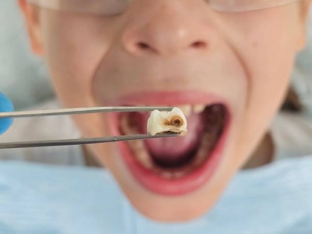 Best Emergency Dental Care for Broken or Chipped Teeth in East Valley, NV